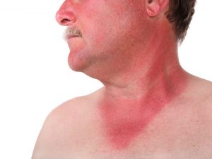 Sunburns (Photo Credit: Organic Facts) Read Risks while Travelling to SEA with Backyard Tour Malaysia
